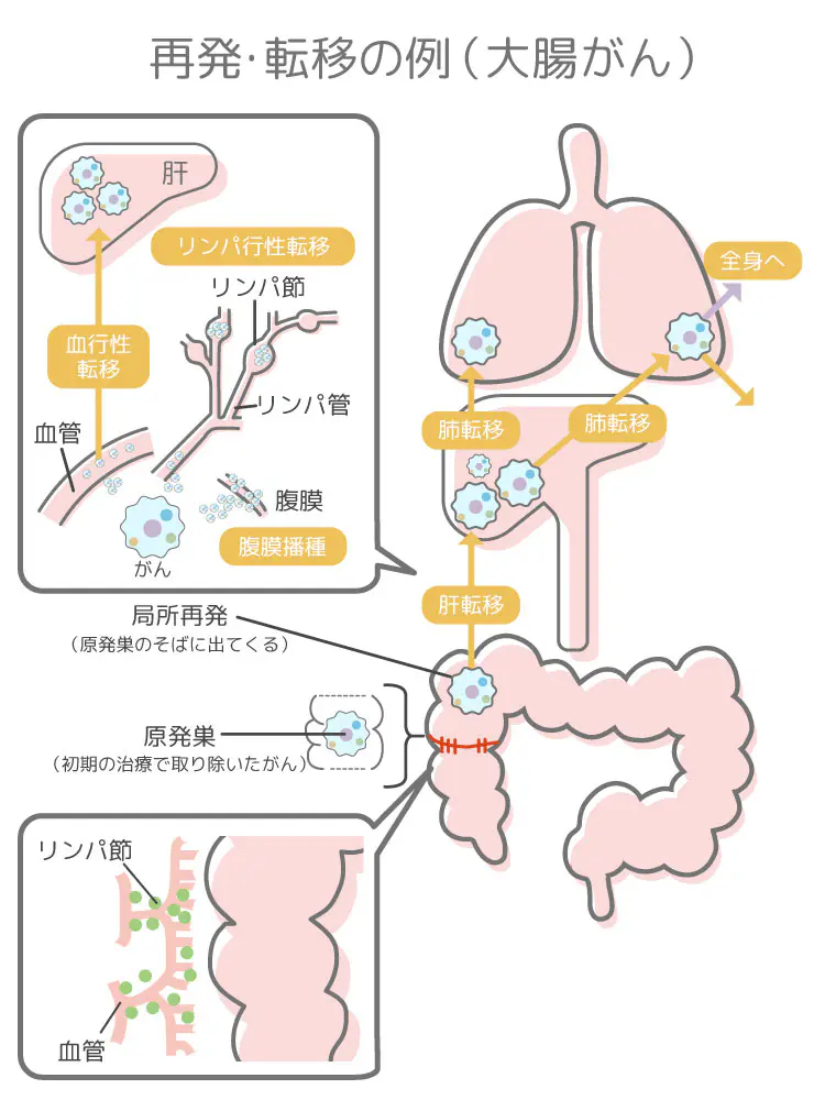 再発・転移の例(大腸がん)